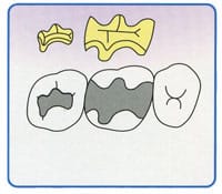 GoLd Inlay（ゴールドインレー）