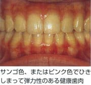 歯周病の進行状況