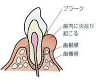 歯周病の進行状況