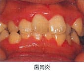 歯周病の進行状況