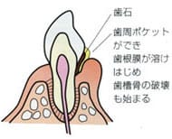 歯周病の進行状況