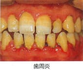 歯周病の進行状況