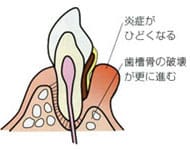 歯周病の進行状況