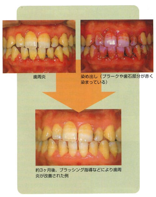 歯周病を防ぐ、プラークコントロール