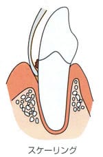 スケーリング（歯石除去）をしてもらう